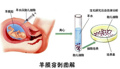 台湾孕妇做羊膜穿刺感染细菌 母子双亡