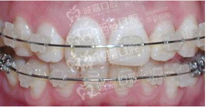 牙齿矫正的最佳年龄