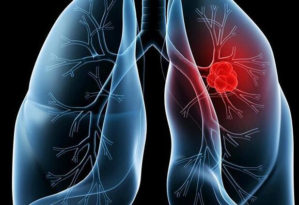 八成肺癌跟吸烟有关 早期筛查得靠低剂量螺旋CT