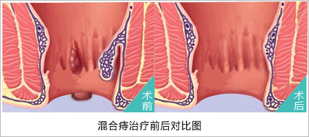 痔疮属于医保范围吗 混合痔医保