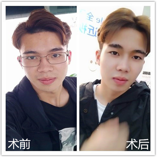 就是不一样18岁摘镜帅气逆袭icl手术后视力12