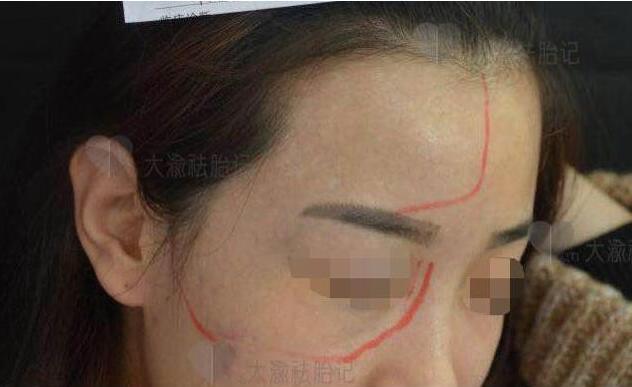 因胎记女子求职多次被拒