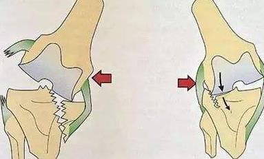 不要随便做按摩 对于骨刺的患者来说,在发现自己的关节部位有不适症状