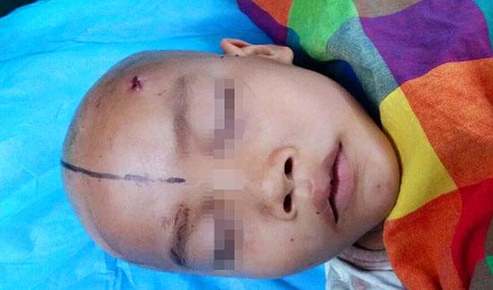 8岁男孩被玩具枪爆头 医生脑中取钢珠救命