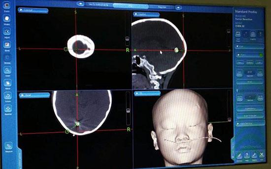 8岁男孩被玩具枪爆头 医生脑中取钢珠救命