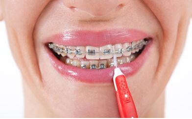 牙齿矫正时清理牙齿的方法