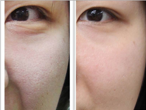 毛孔粗大怎么办?