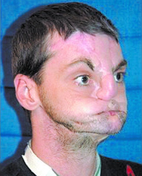 男子遭枪击面目全毁 换脸工程创世界之最