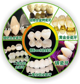 重庆做烤瓷牙的种类有哪些?