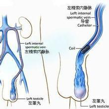 男人精索静脉曲张可以预防吗?