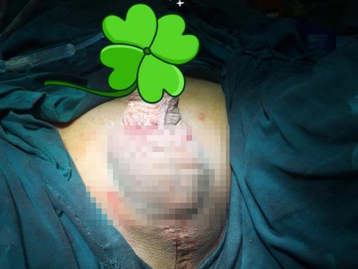 小伙摔成尿失禁和重度ED 人工假体助他重拾性