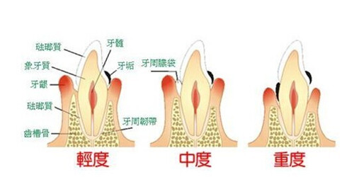 牙周炎怎么治疗方法有哪些