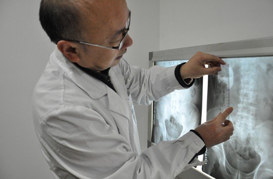 二十多年养出西南最大结石 三次手术清除顽石