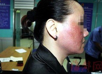 芦荟敷脸治青春痘15岁女孩外号关公险不想_约女生毁容图片