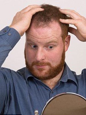 <em>头发</em>猛掉?算算你何时会<em>谢顶</em>|常见病|华媒时讯网