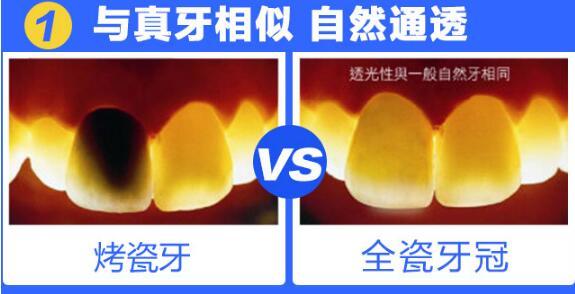 烤瓷牙和全瓷牙的区别有哪些_大渝网_腾讯网