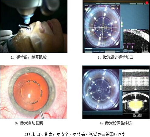 重庆飞秒激光技术 白内障的救星