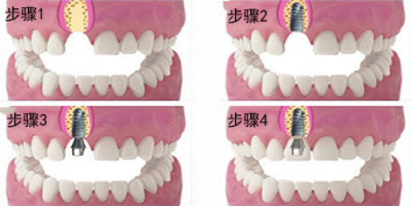 种植牙手术必须知道的常识