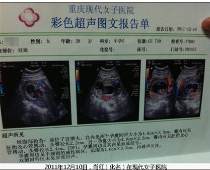 4年不孕一怀就4胞胎愁坏家人 成功减为双胞胎