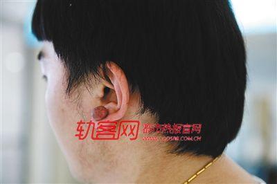 小伙5年前追潮流打耳洞 如今耳垂长出肉疙瘩