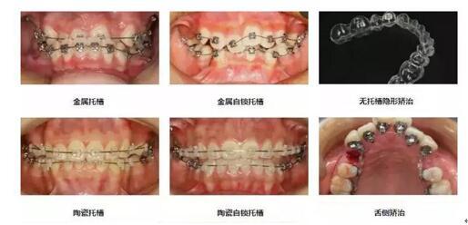 牙齿矫正反变龅牙妹 高三少女后悔莫及