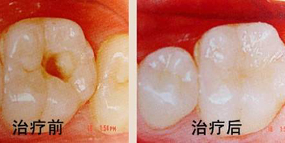 牙齿有洞补要多少钱_大渝网_腾讯网
