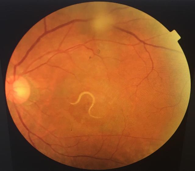 四川大妈左眼长出5毫米寄生虫 重庆眼科专家诊断：虫从口入！_大渝网_腾讯网