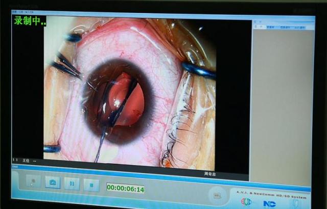 爱尔眼科江北医院实施重庆首例ICL V4C晶体植