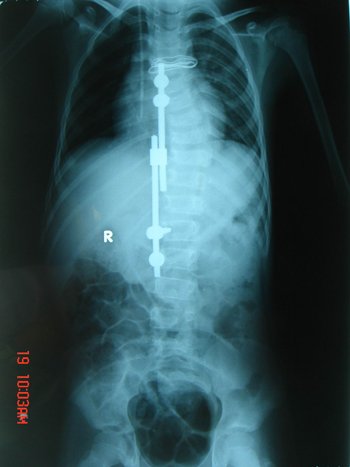 12岁男孩脊柱扭成麻花 专家手术男孩挺直腰杆