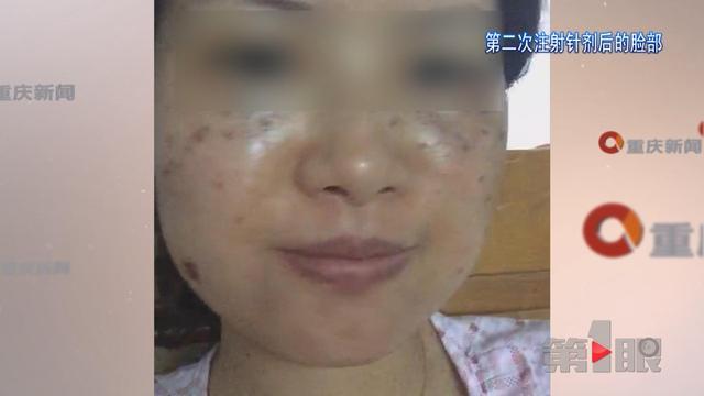 女子微信找人除斑反进医院 满脸水泡皮肤又红