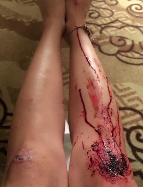 [ 摘要]李念晒触目惊心腿部受伤照片,据称其中一条腿是真受伤,另一