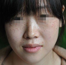 激光 祛疤 部位 结痂 激光 治疗 面部 疤痕 医生 配 了 ...