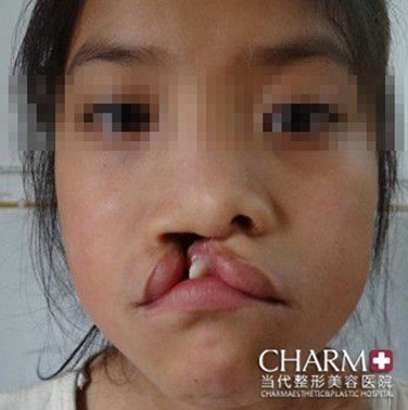12岁女孩患先天性唇腭裂