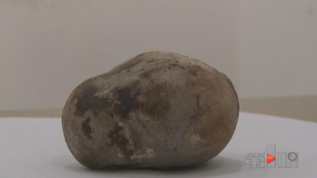 八旬大爷腹痛20年 肚里藏块“鹅卵石”
