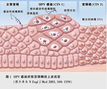 权威专业治疗HPV病毒