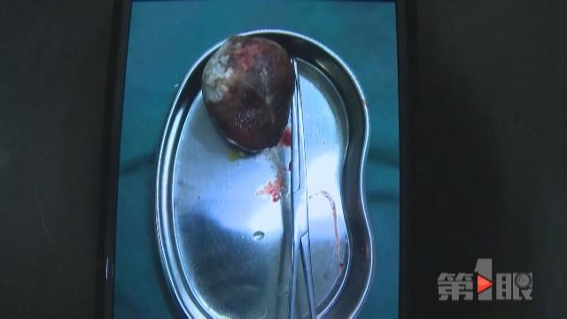 八旬大爷腹痛20年 肚里藏块“鹅卵石”