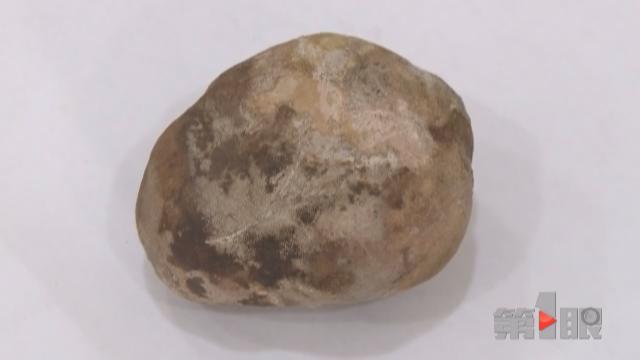 八旬大爷腹痛20年 肚里藏块“鹅卵石”