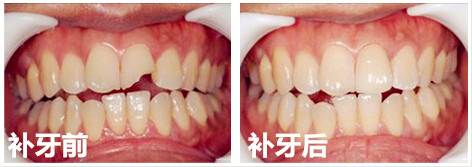 重庆补牙多少钱一颗