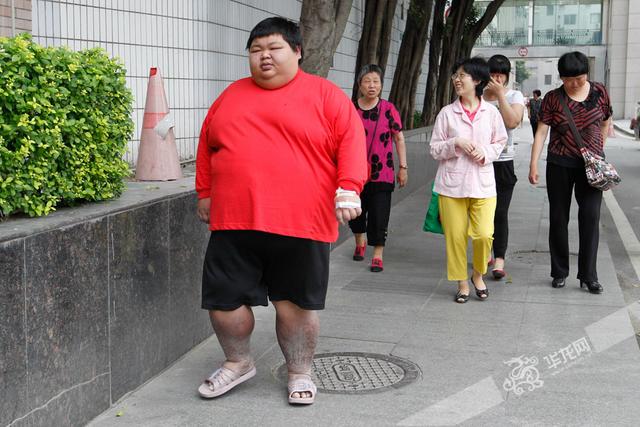 胖也是一种病 重庆90后男孩重348斤不得不切