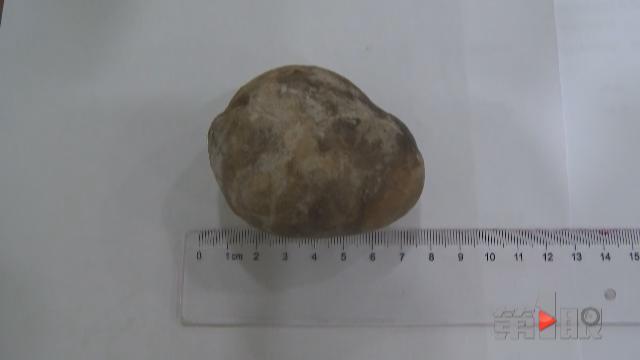 八旬大爷腹痛20年 肚里藏块“鹅卵石”