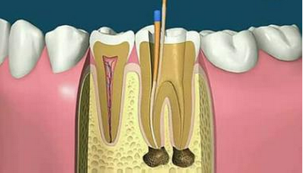 根管治疗后牙齿寿命长吗?