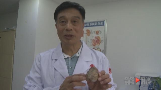 八旬大爷腹痛20年 肚里藏块“鹅卵石”