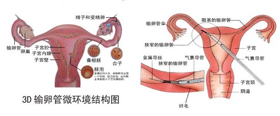 输卵管不通制约生育 3d技术为精卵搭鹊桥_大