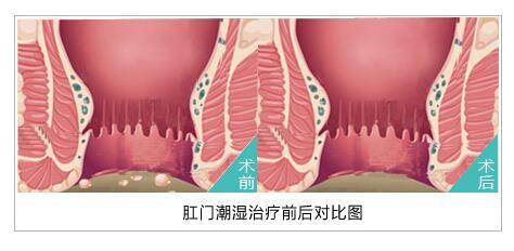 重庆哪里治疗肛门潮湿好重庆医博肛肠医院