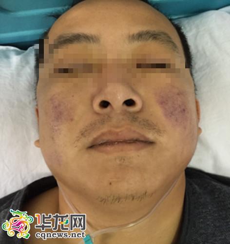 男子从非洲回重庆后染恶性疟疾 青蒿素救了他