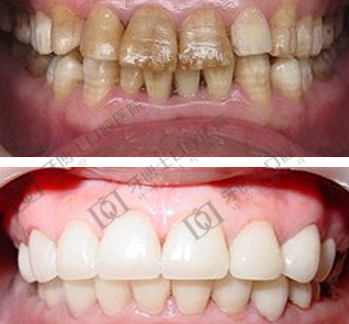 美牙冠改变四环素牙 工作终于有着落