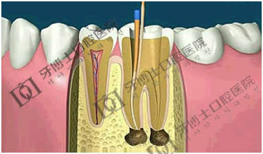 牙齿做根管治疗疼吗?