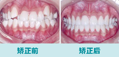 重庆牙齿矫正医院哪家好