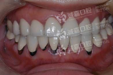 烤瓷牙的危害 诚嘉告诉您