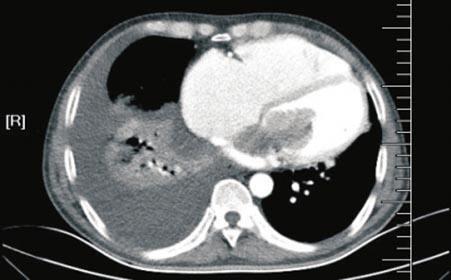 10岁女孩头痛半年被误诊 突发脑血栓晕倒